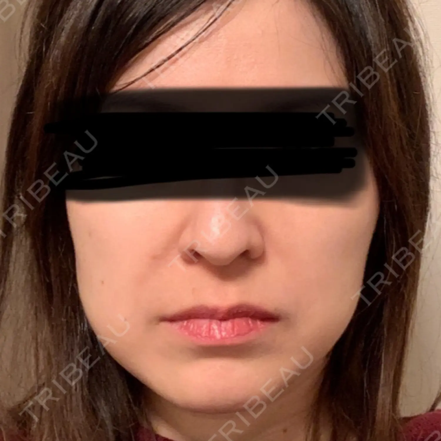 施術前の写真