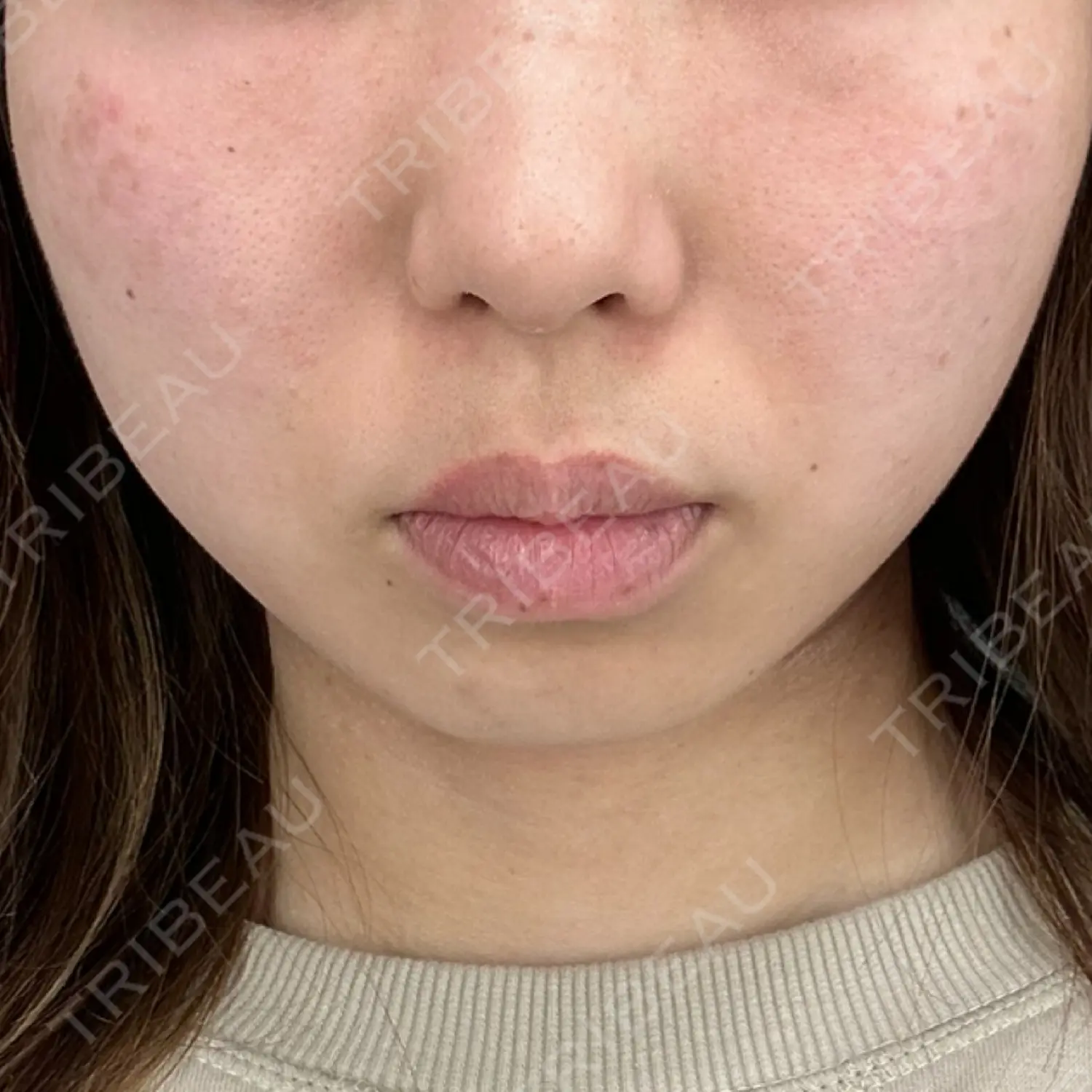 施術前の写真