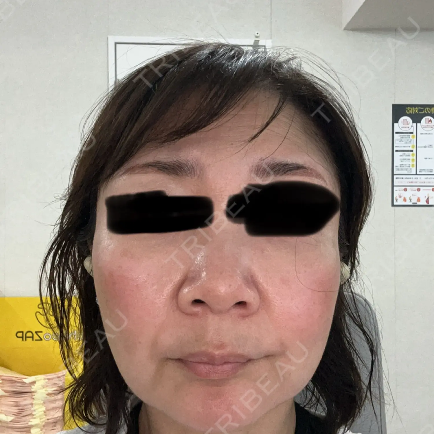 施術前の写真