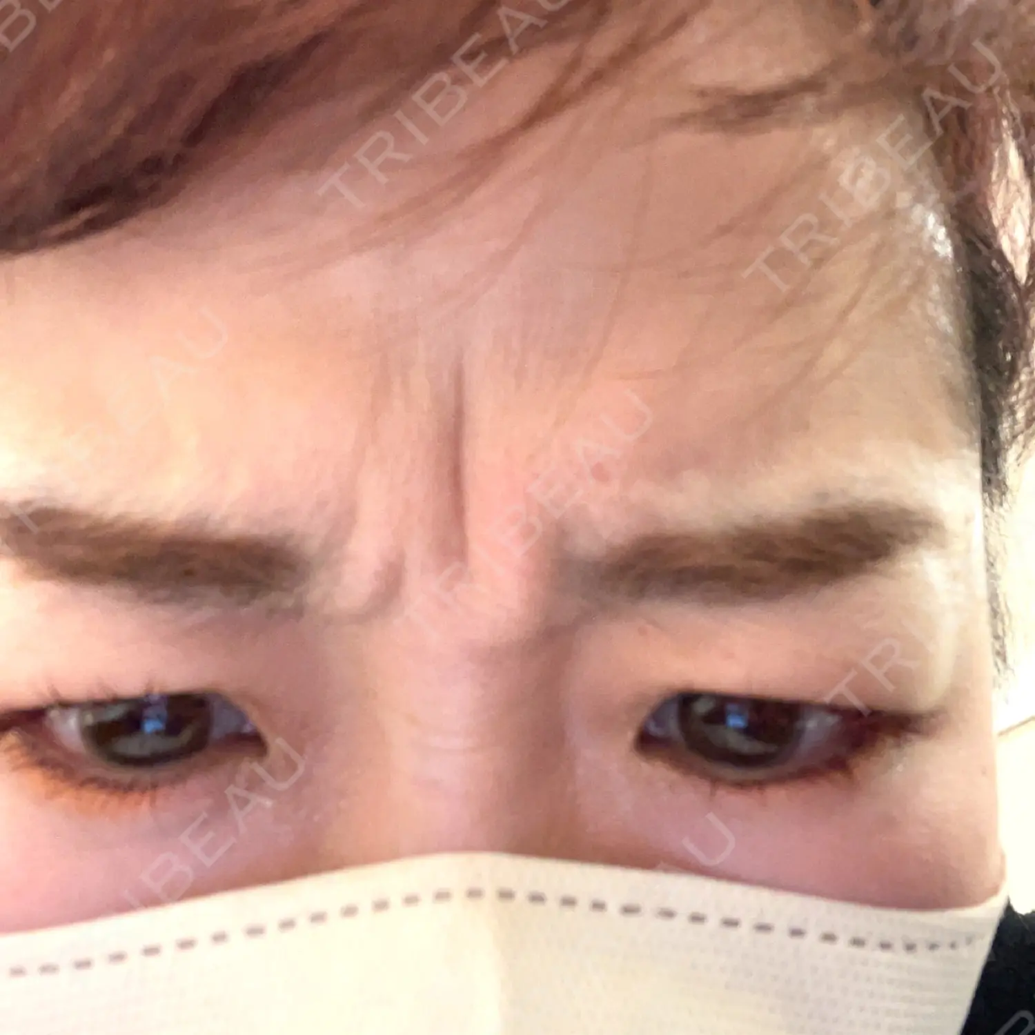 施術前の写真