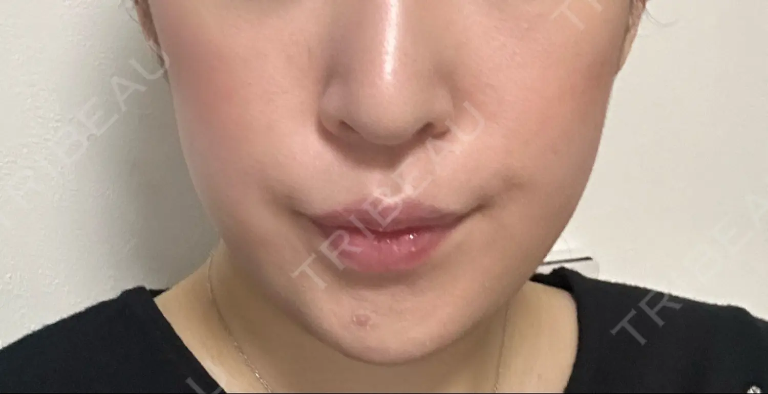 施術前の写真