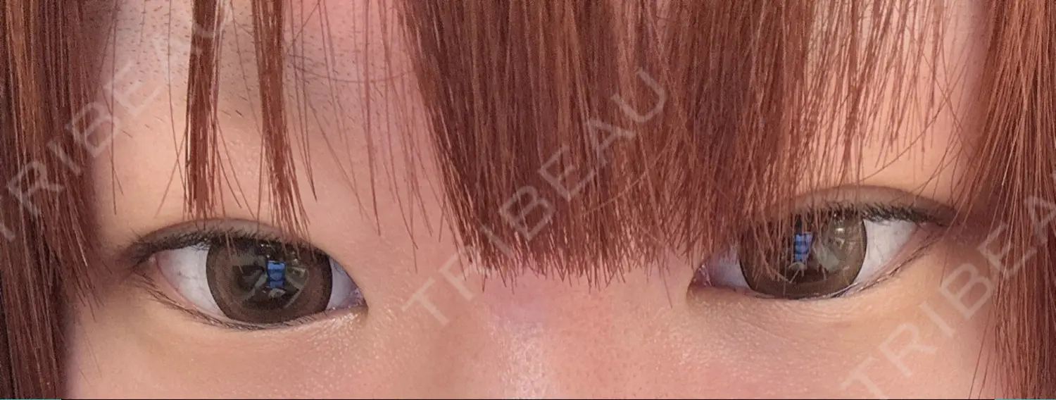 施術前の写真