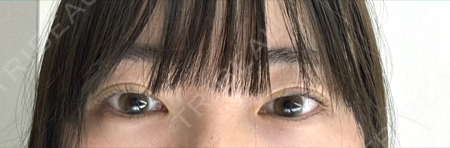 施術前の写真