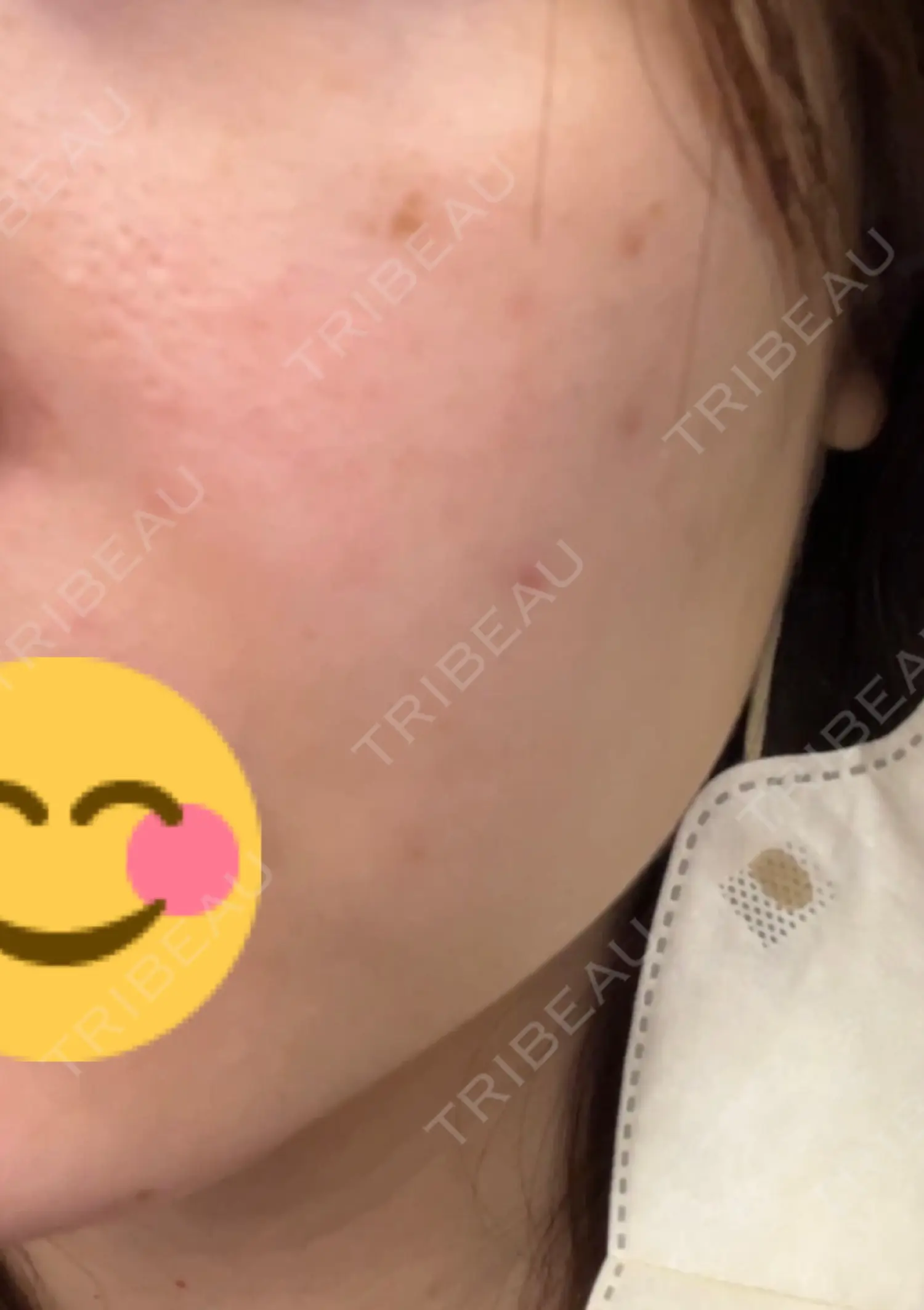 施術前の写真