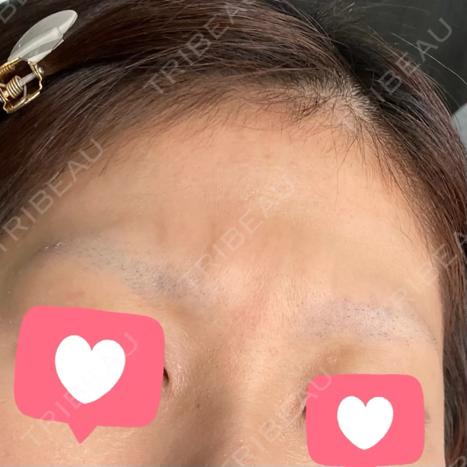 施術前の写真