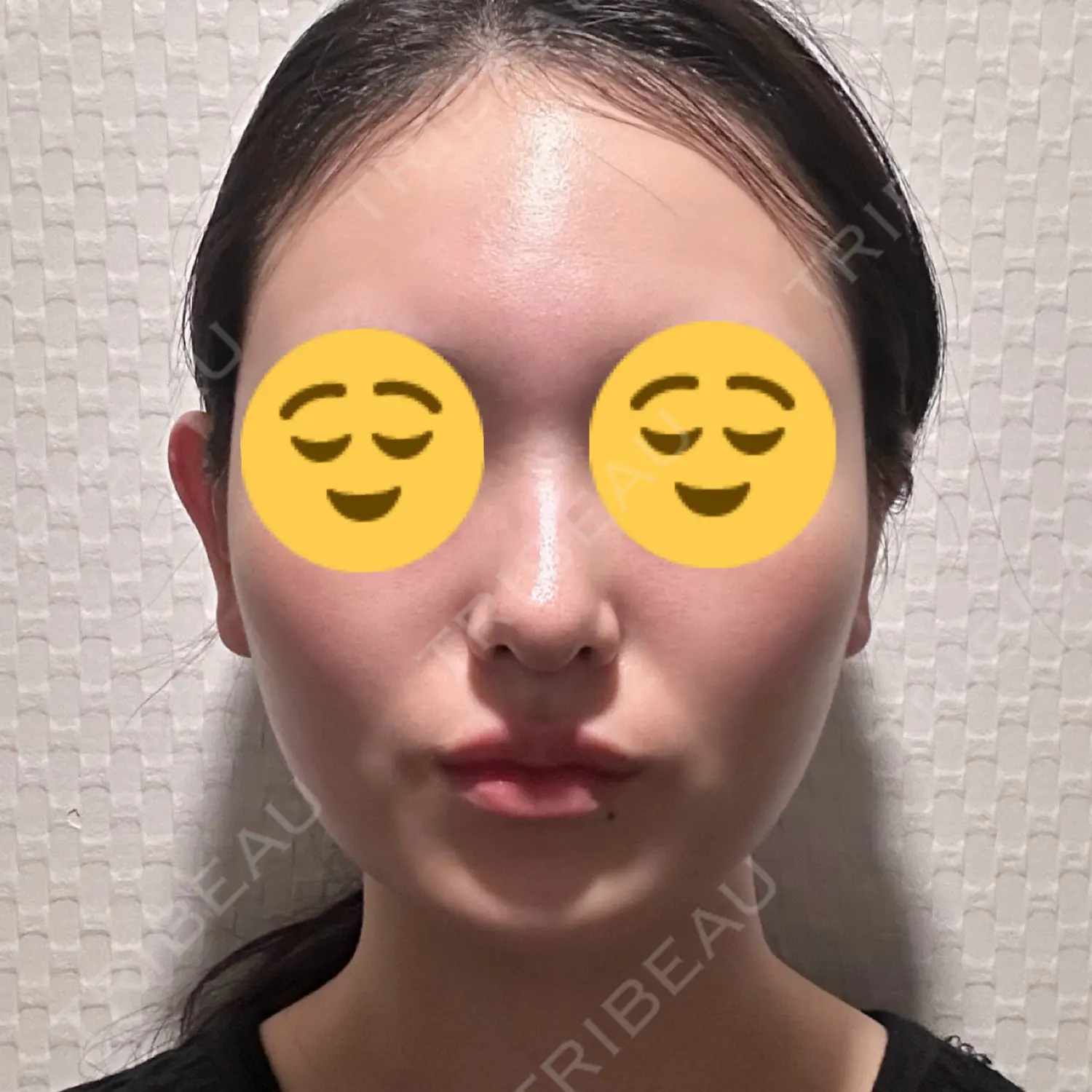 施術前の写真