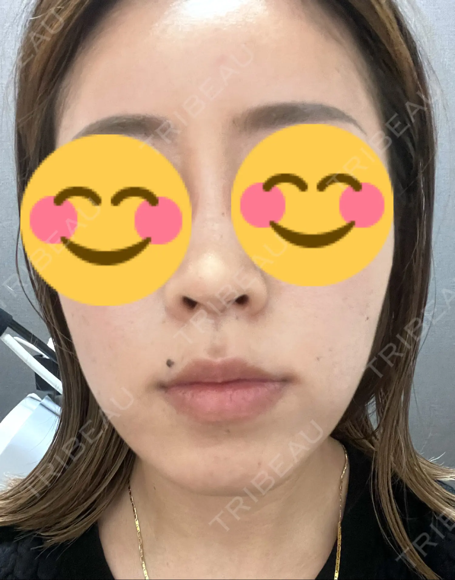 施術前の写真