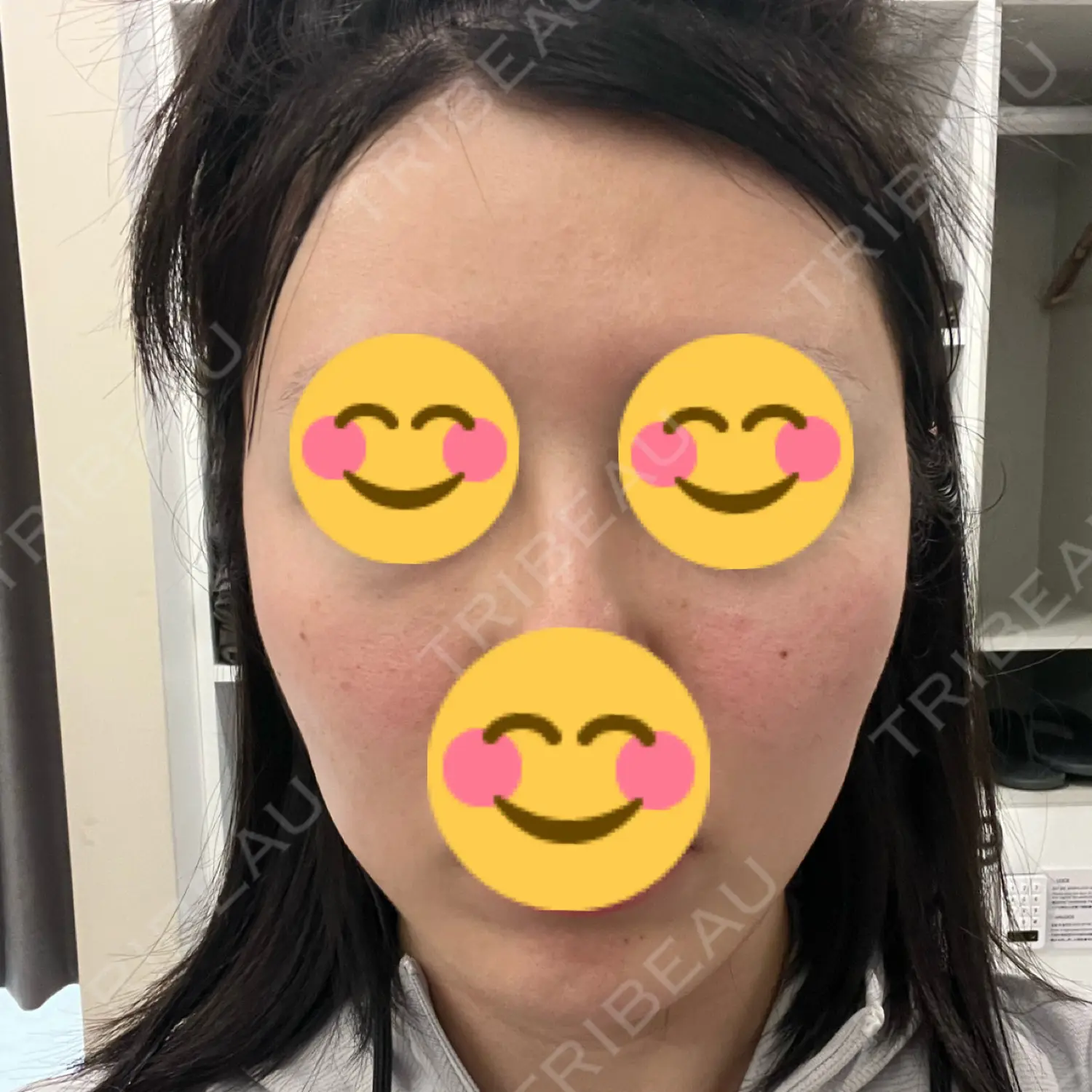 施術前の写真
