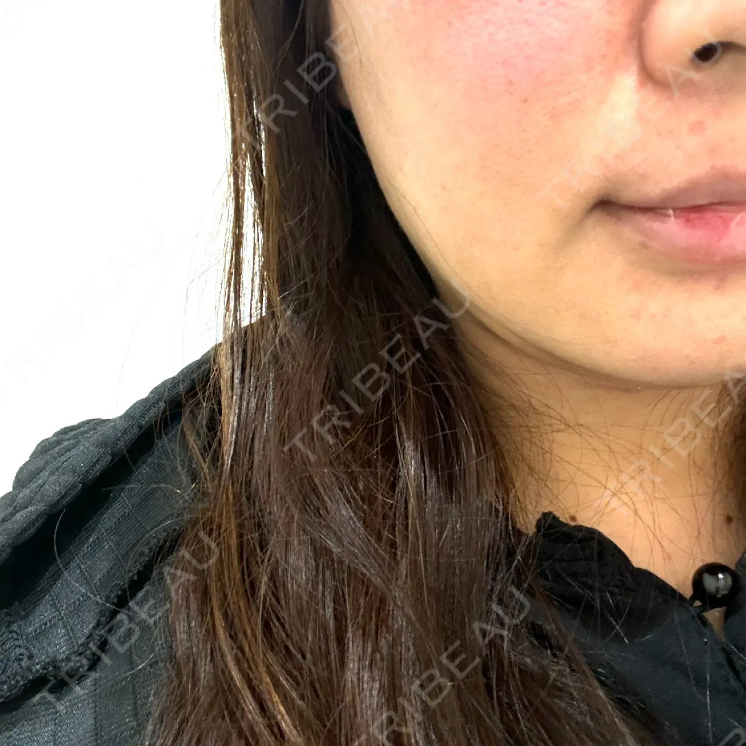 施術前の写真