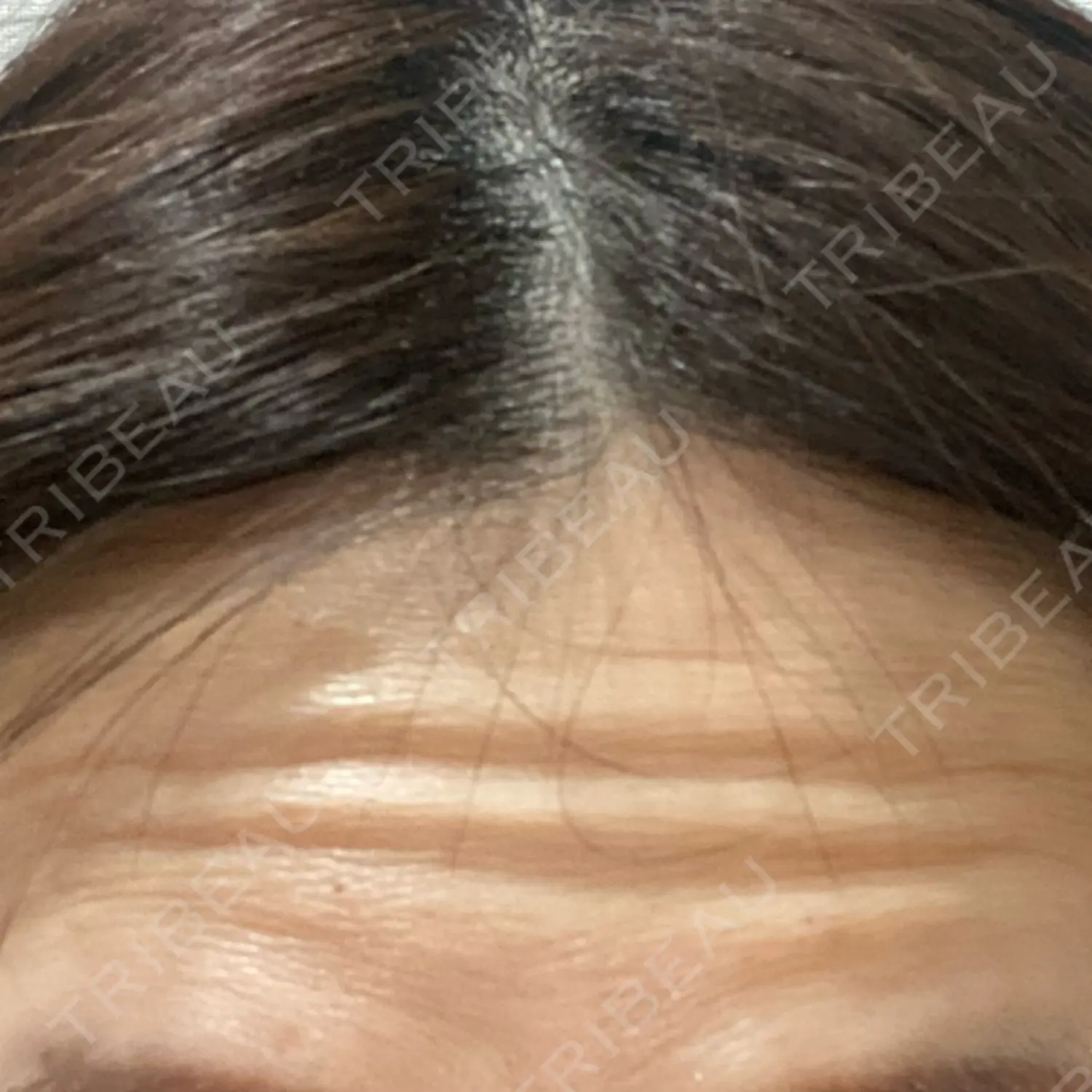 施術前の写真