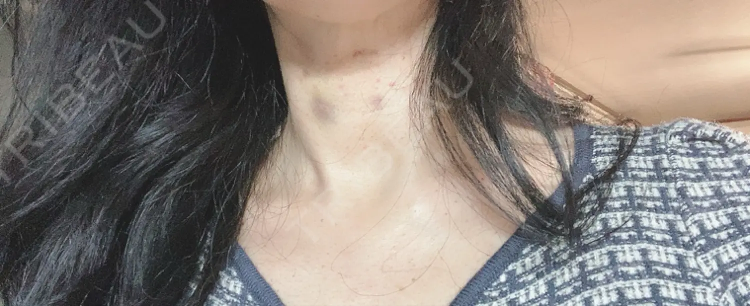 施術前の写真