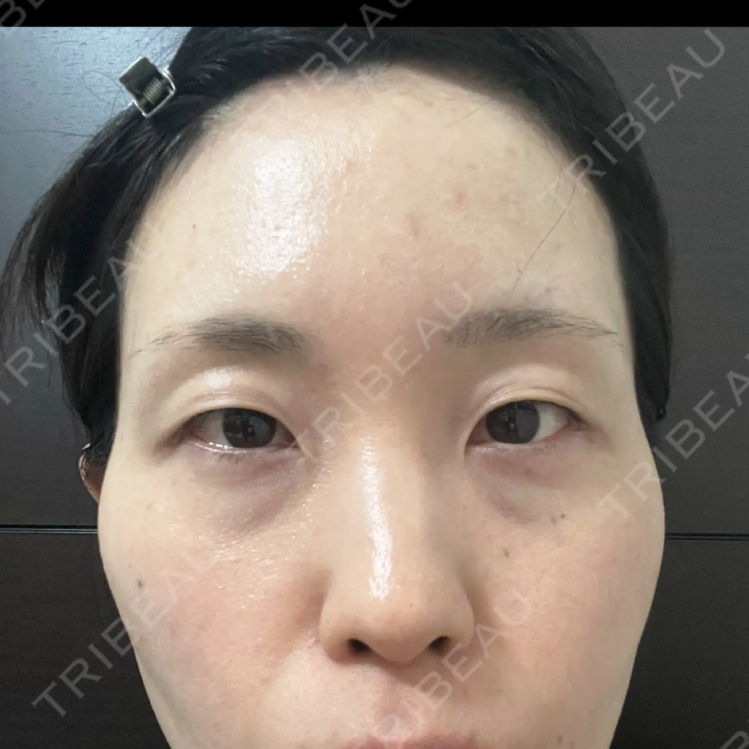 施術前の写真