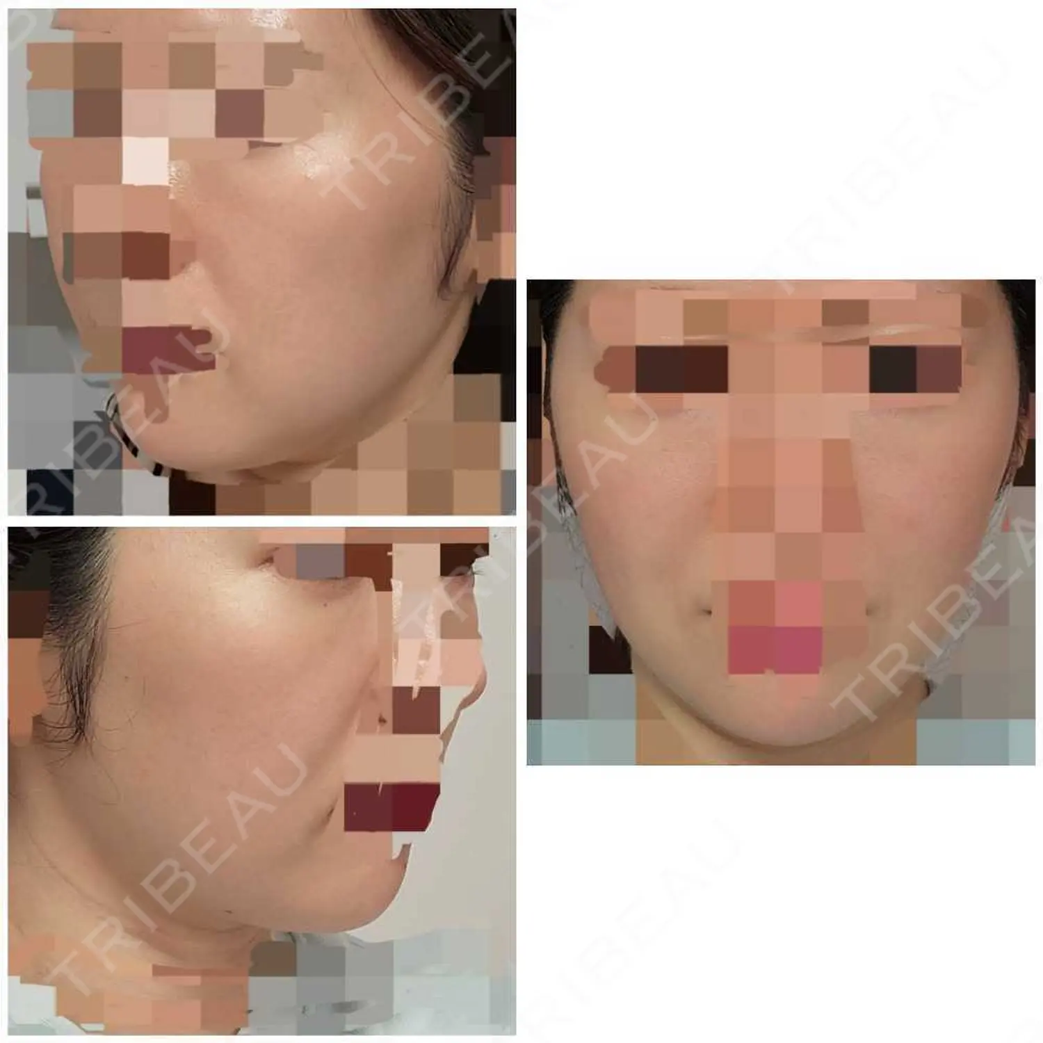 施術前の写真