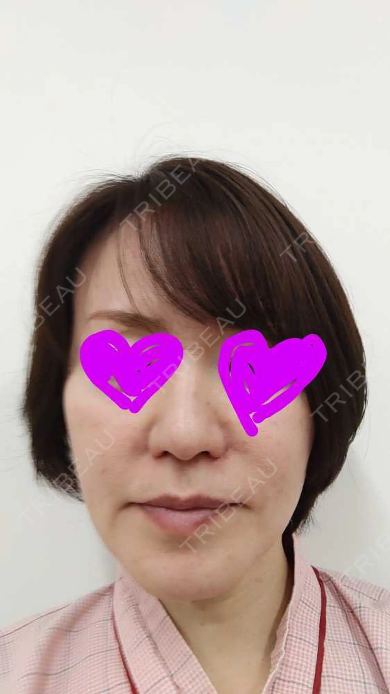 施術前の写真