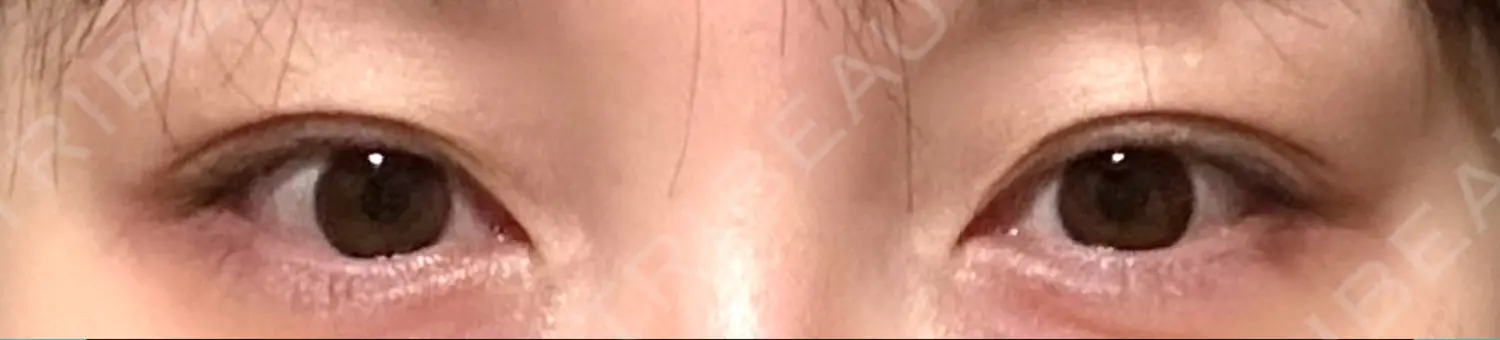 施術前の写真