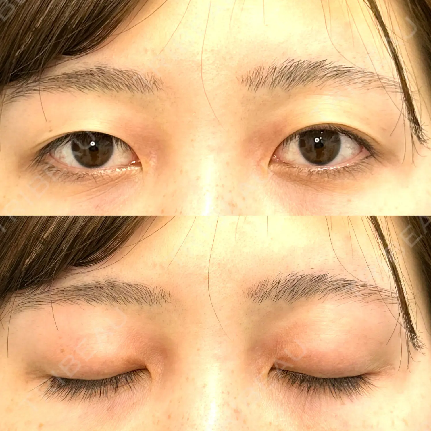 施術前の写真