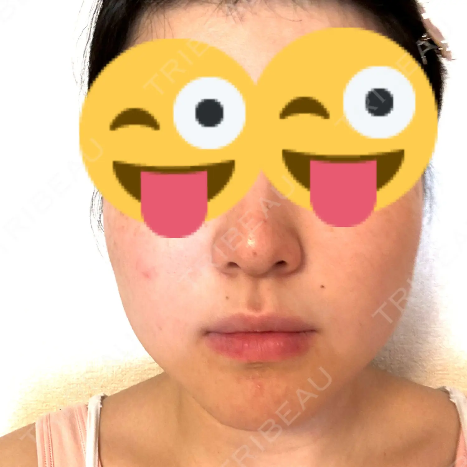 施術前の写真