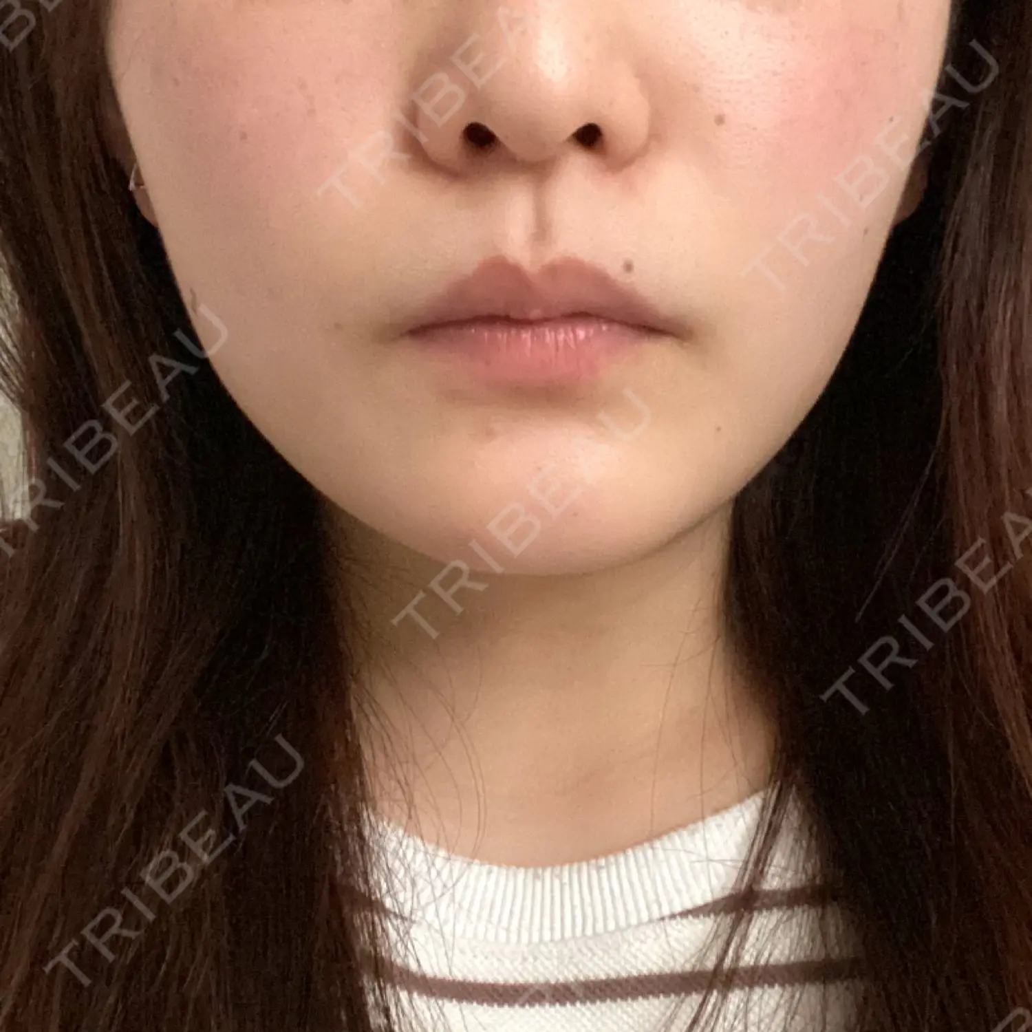 施術前の写真