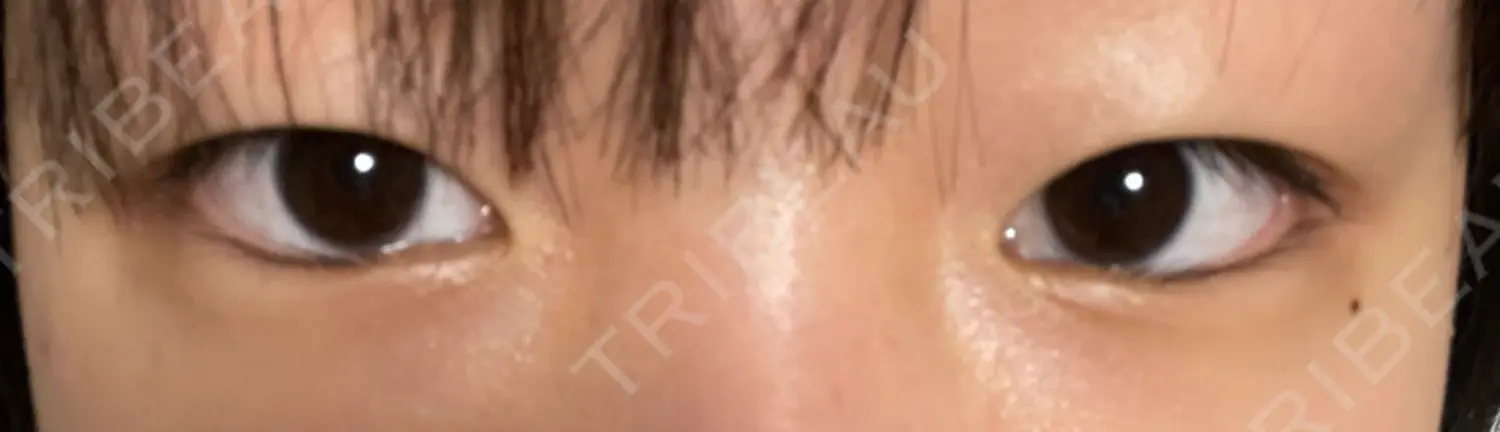 施術前の写真