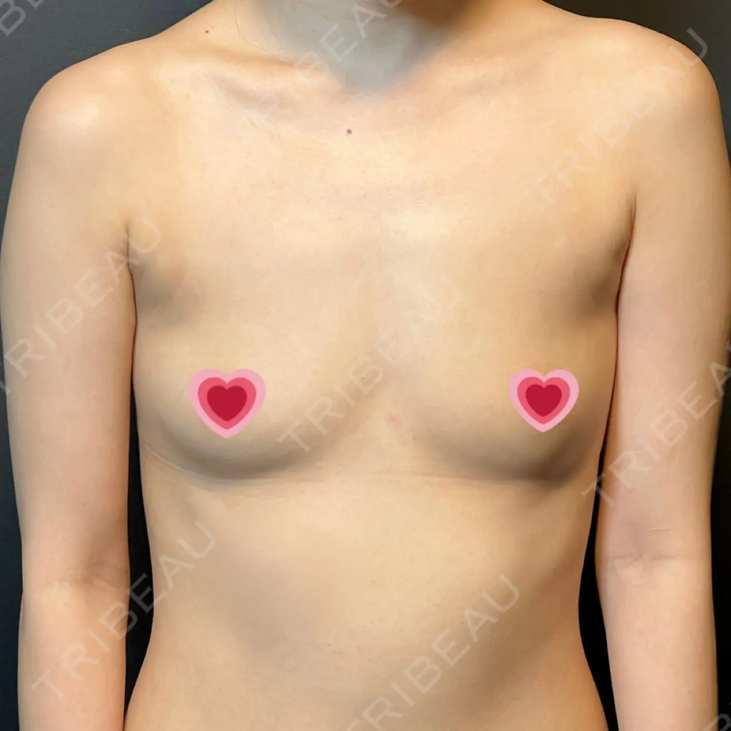 施術前の写真