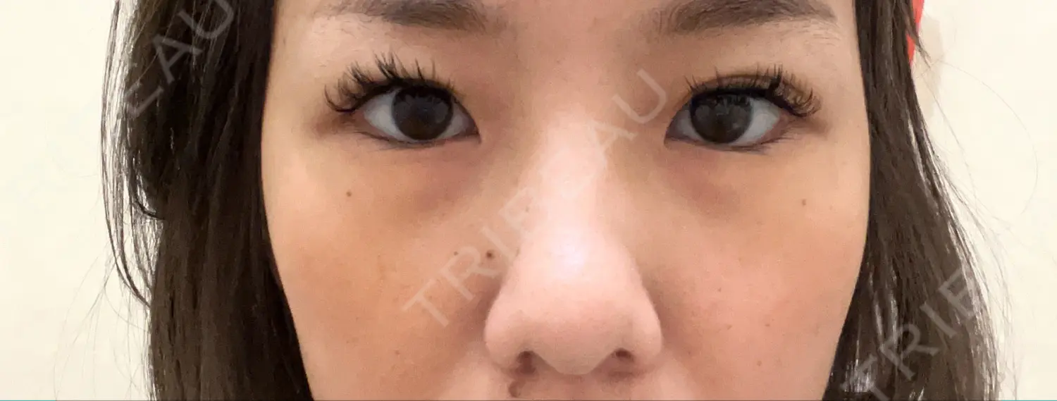 施術前の写真