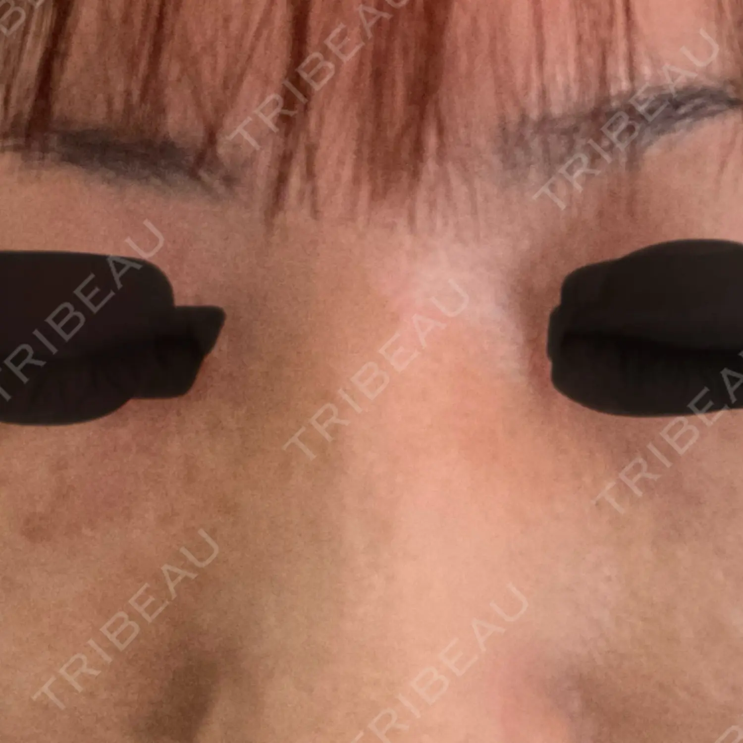 施術前の写真