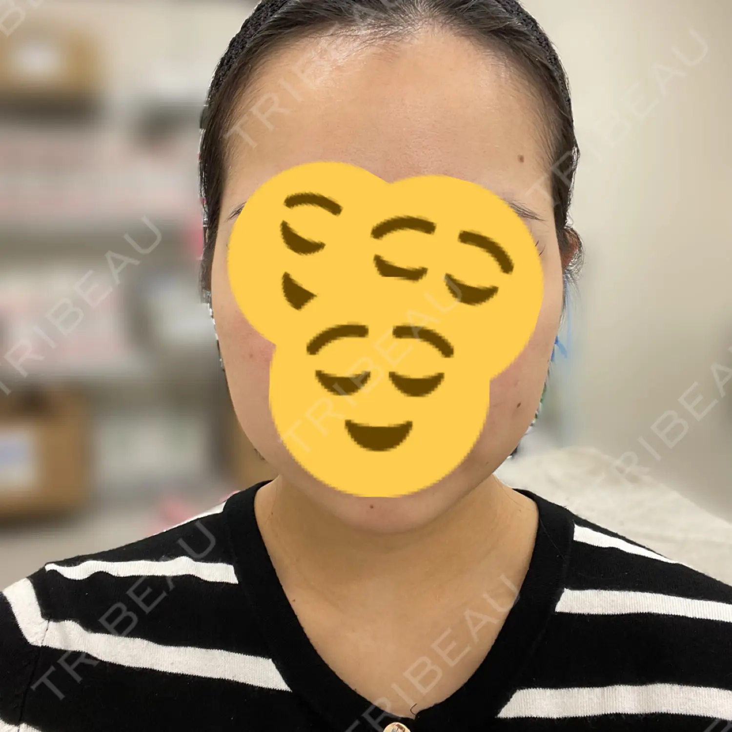 施術前の写真