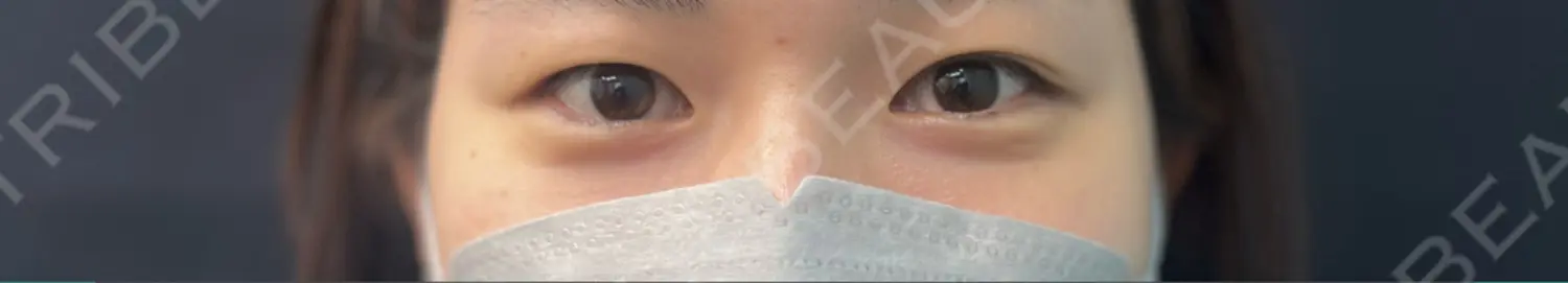 施術前の写真