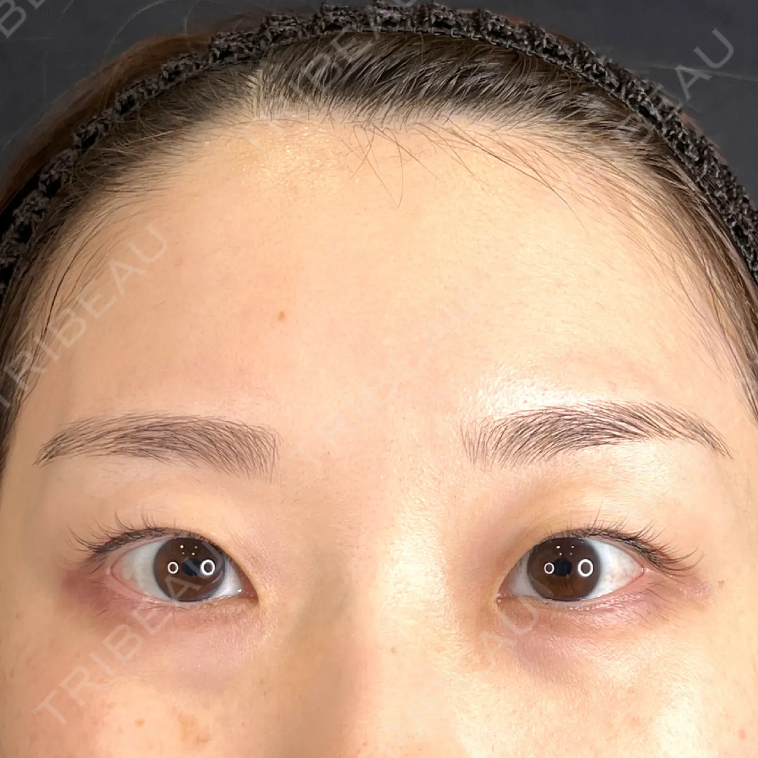 施術前の写真
