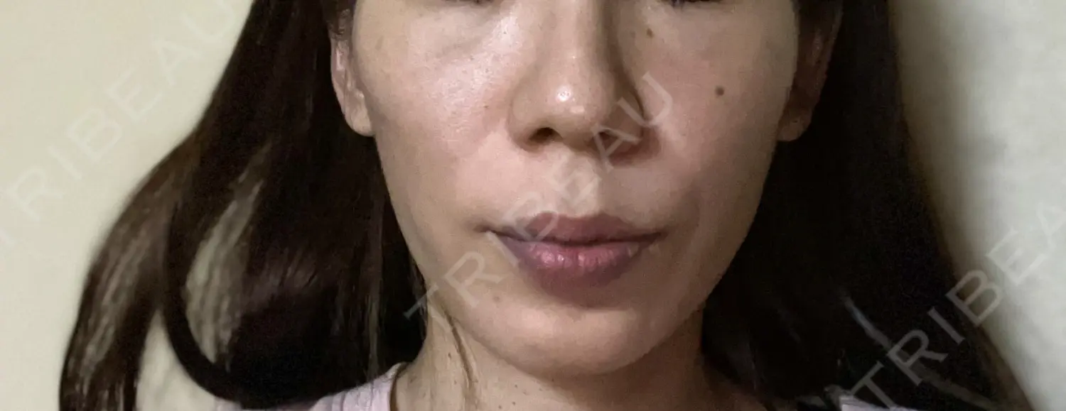 施術前の写真