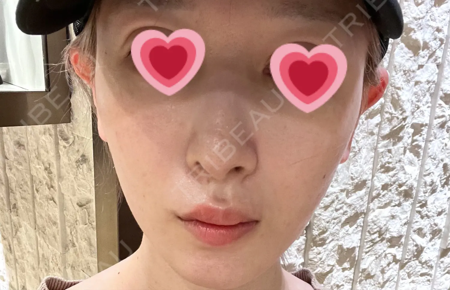 施術前の写真