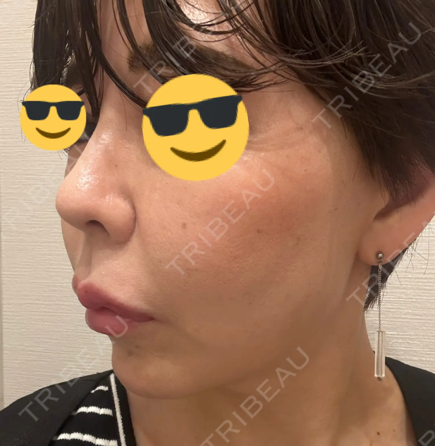 施術前の写真