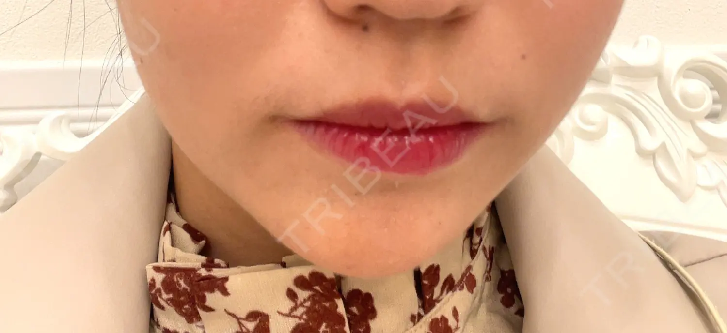 施術前の写真