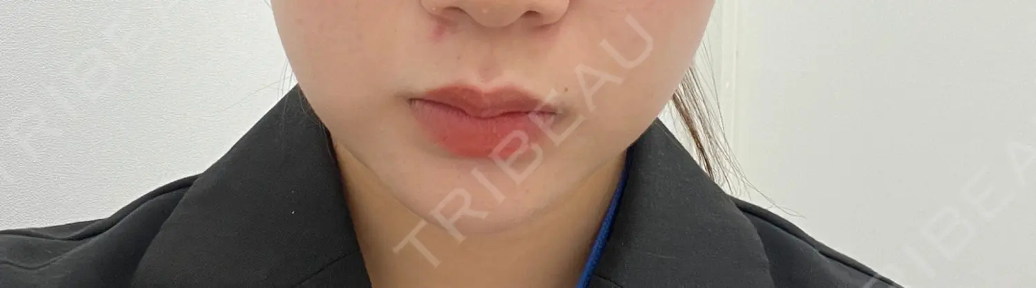 施術前の写真