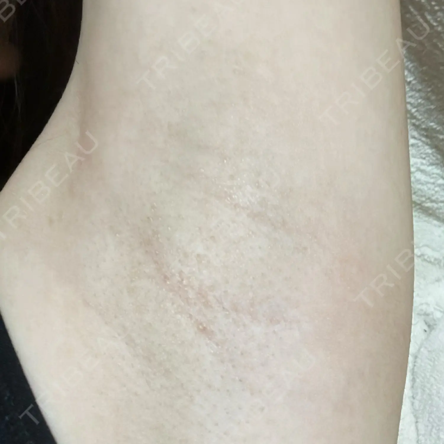 施術前の写真