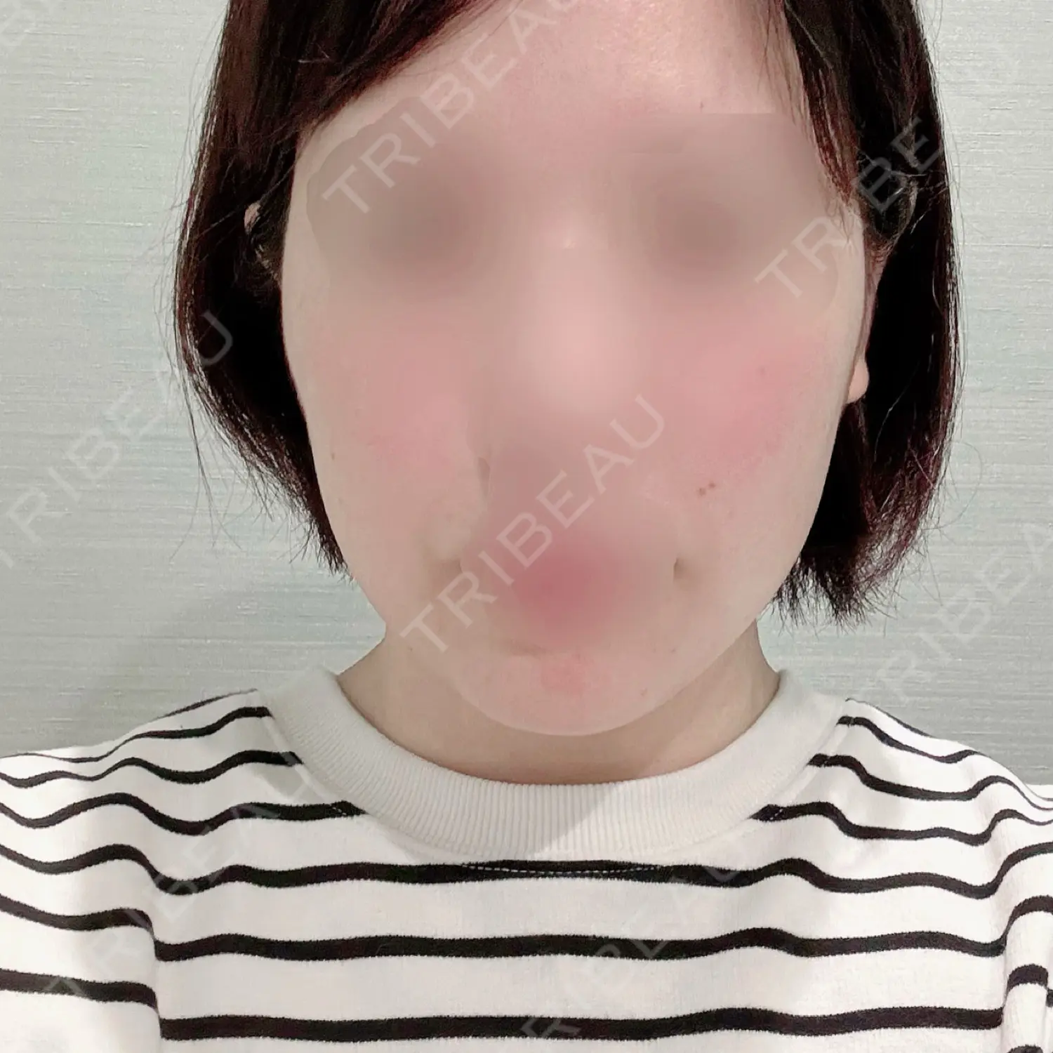 施術前の写真