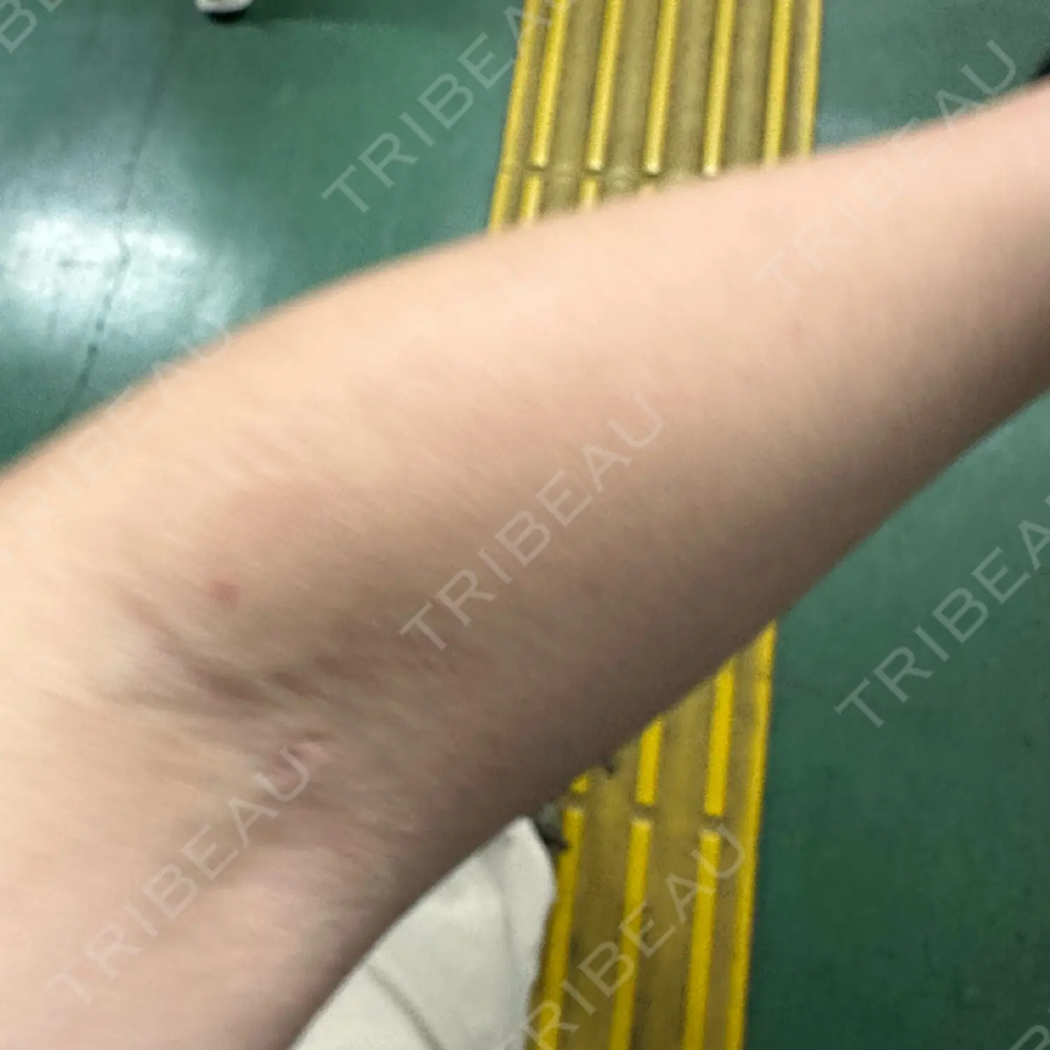 施術前の写真