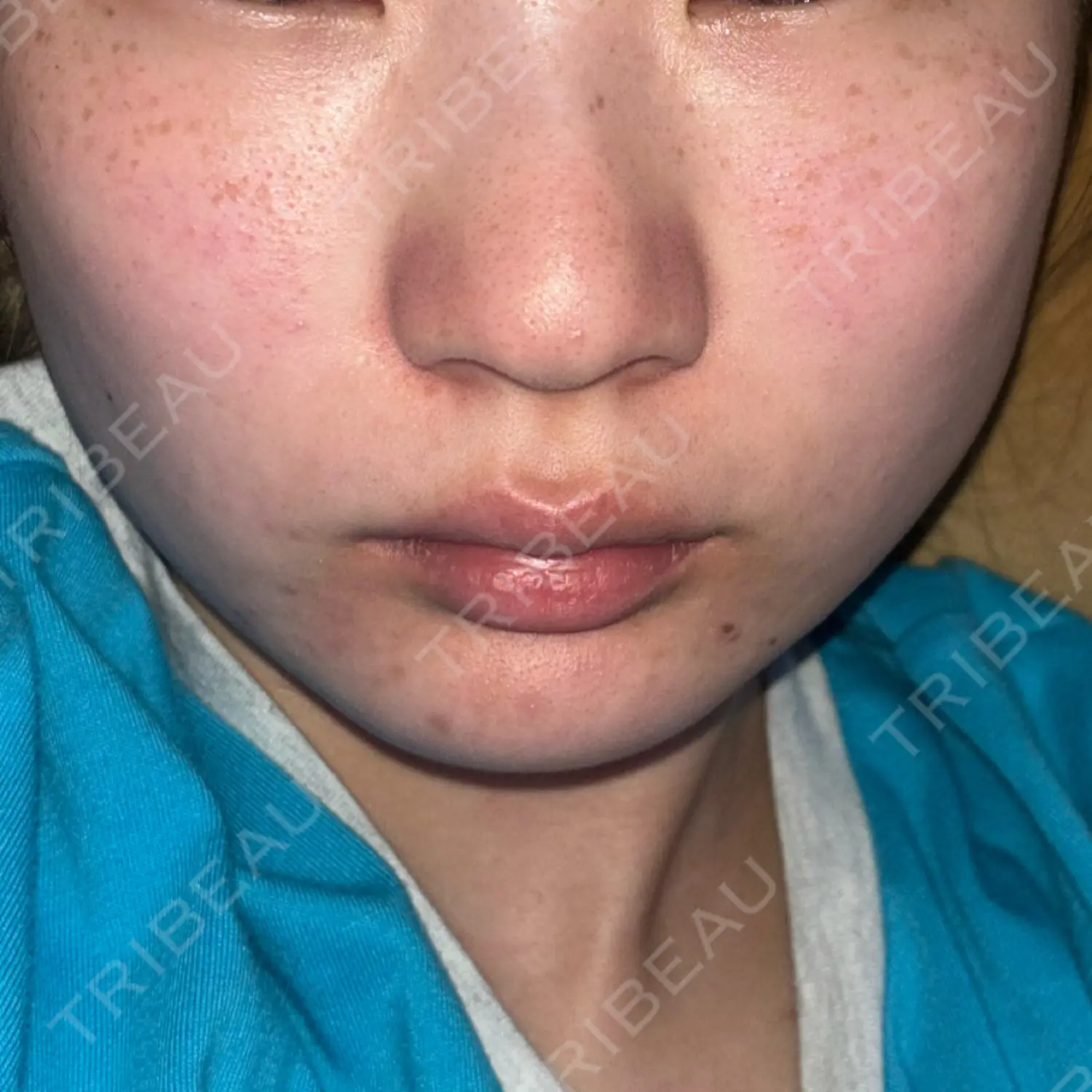 施術前の写真