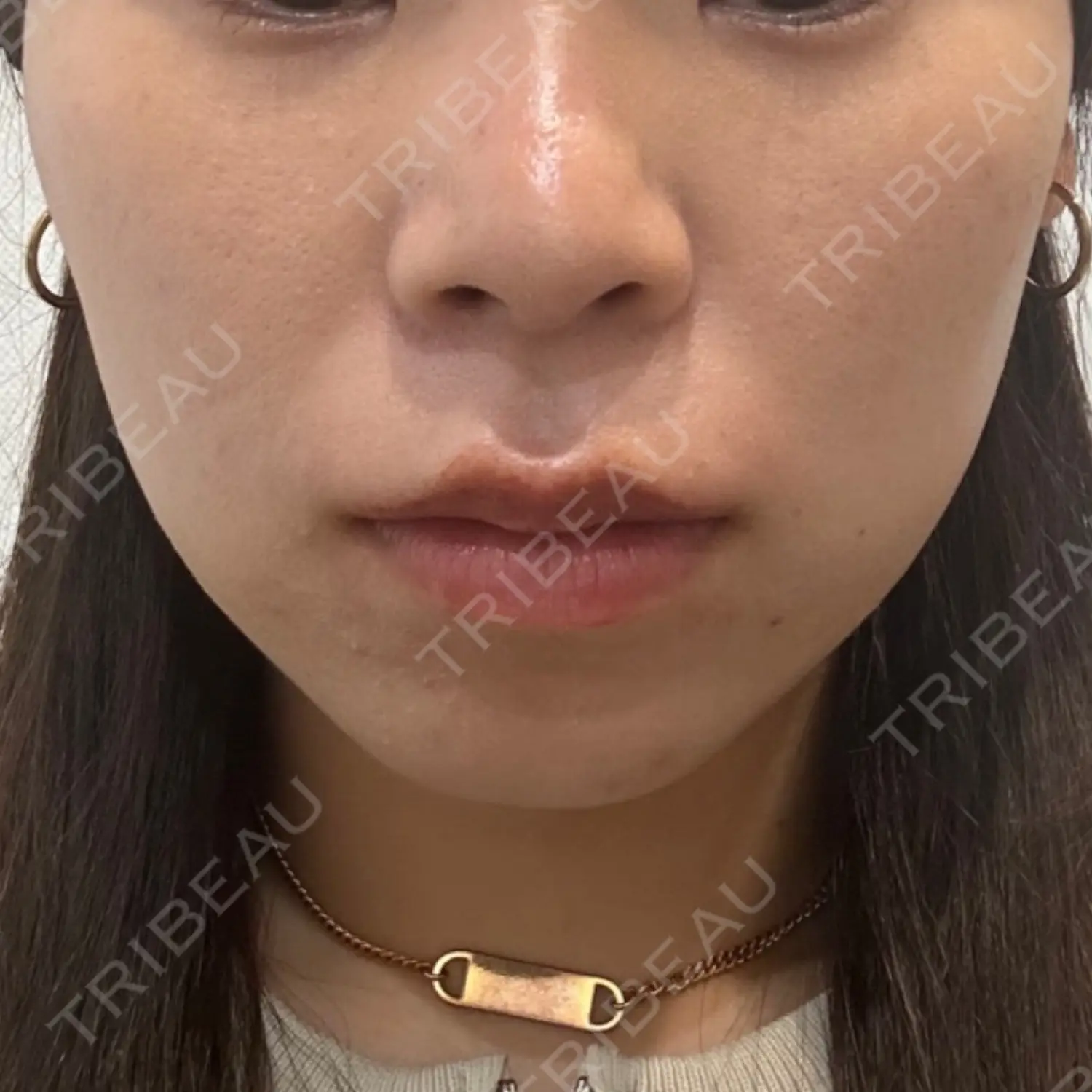 施術前の写真