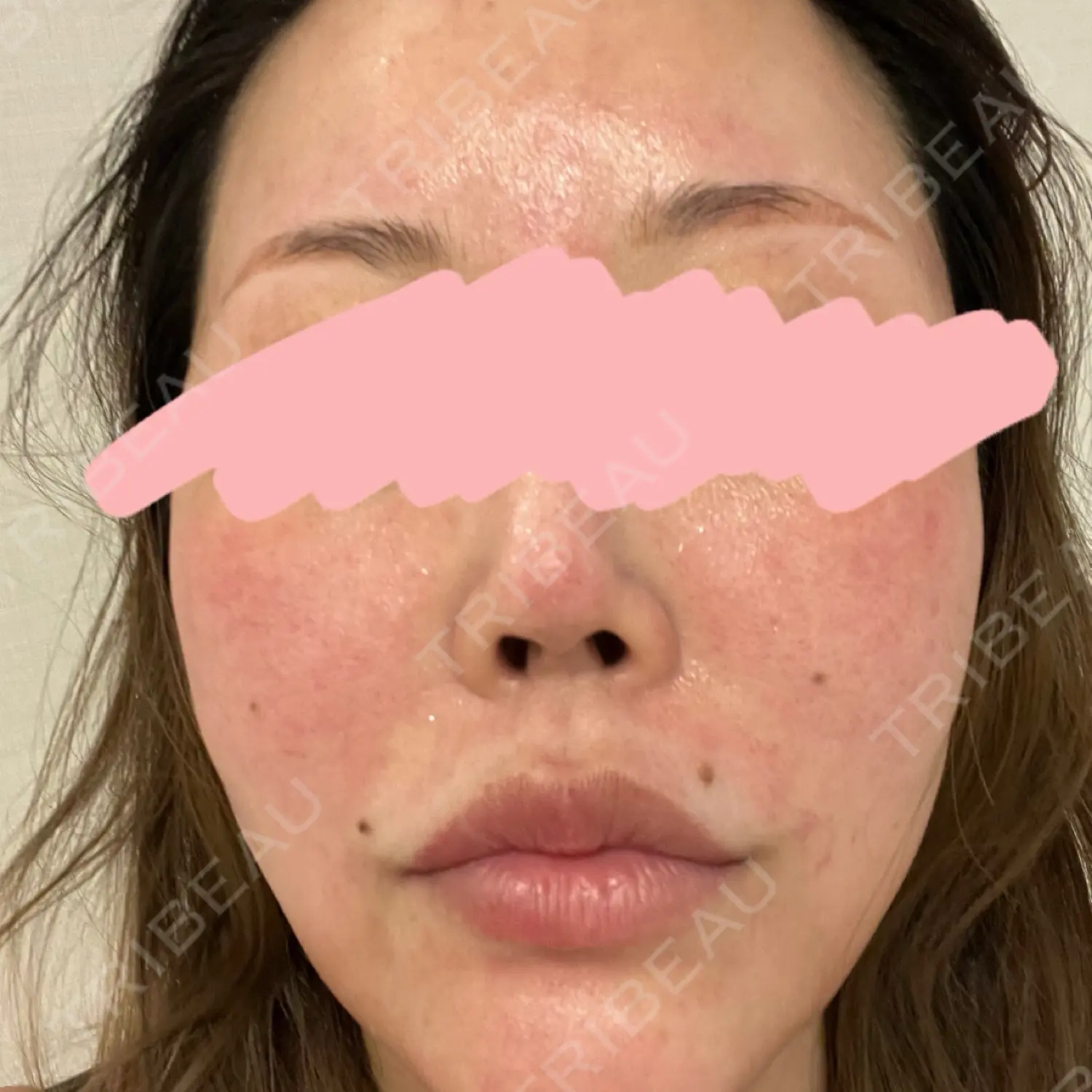 施術前の写真