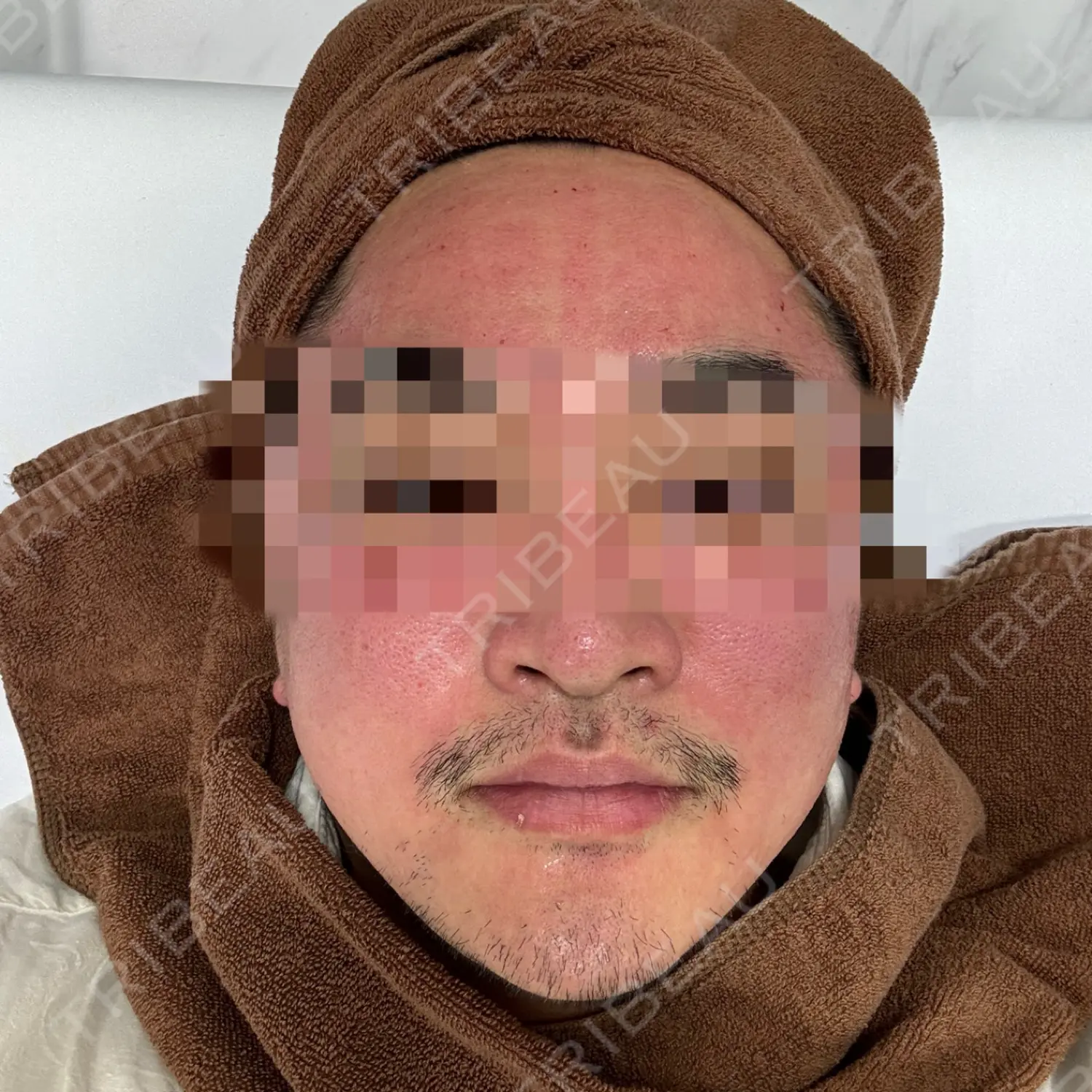 施術前の写真