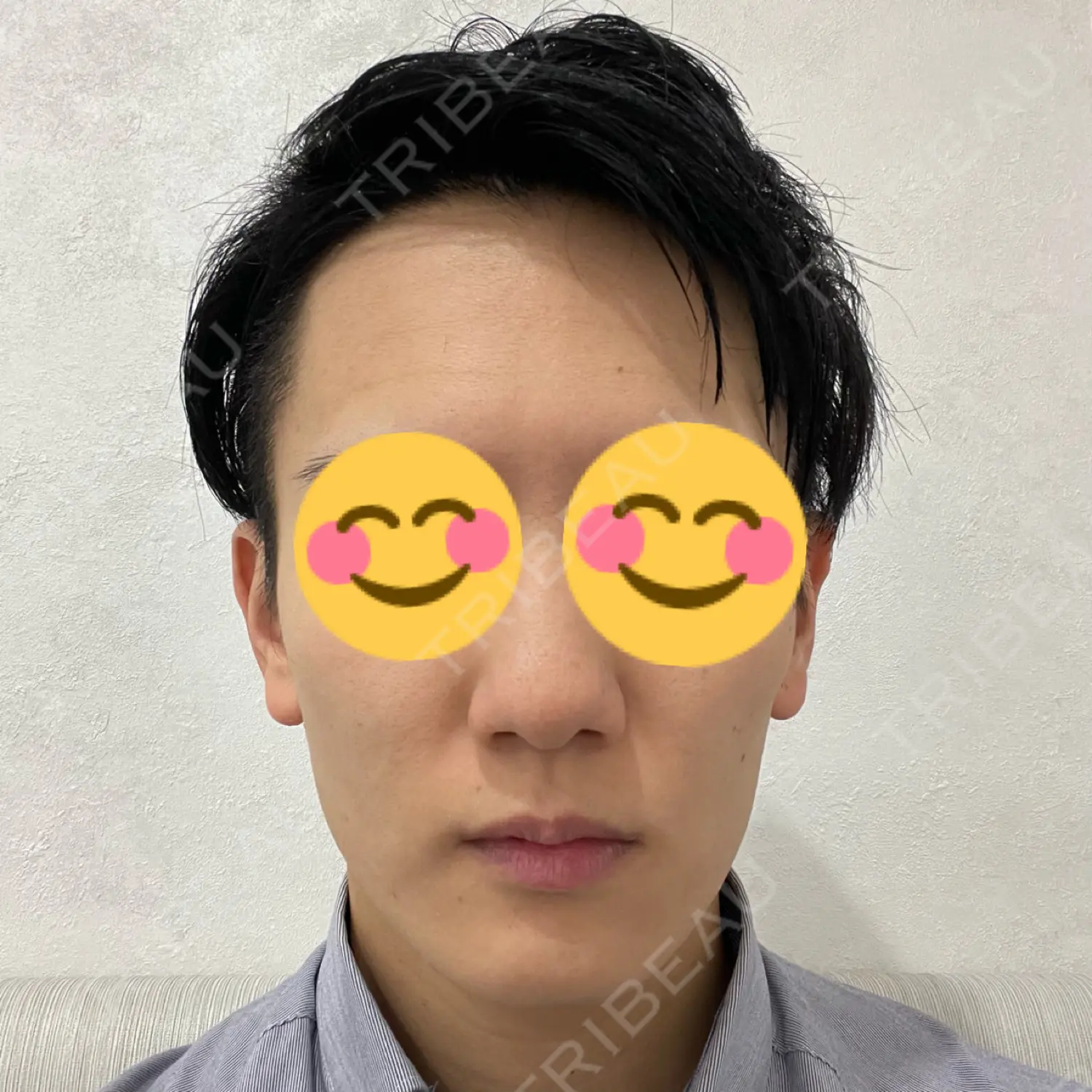 施術前の写真