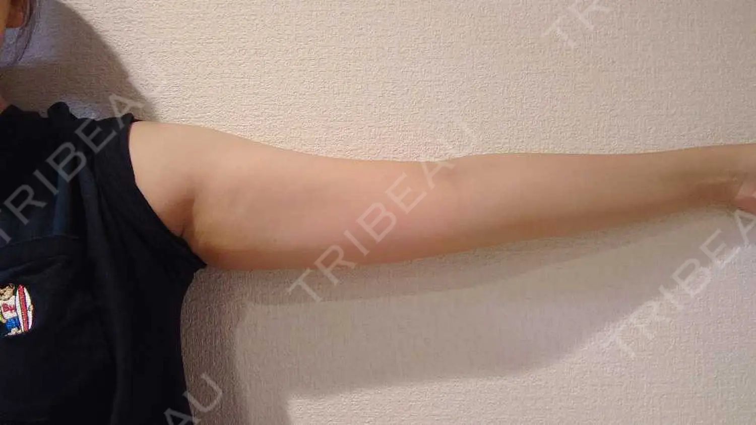 施術前の写真