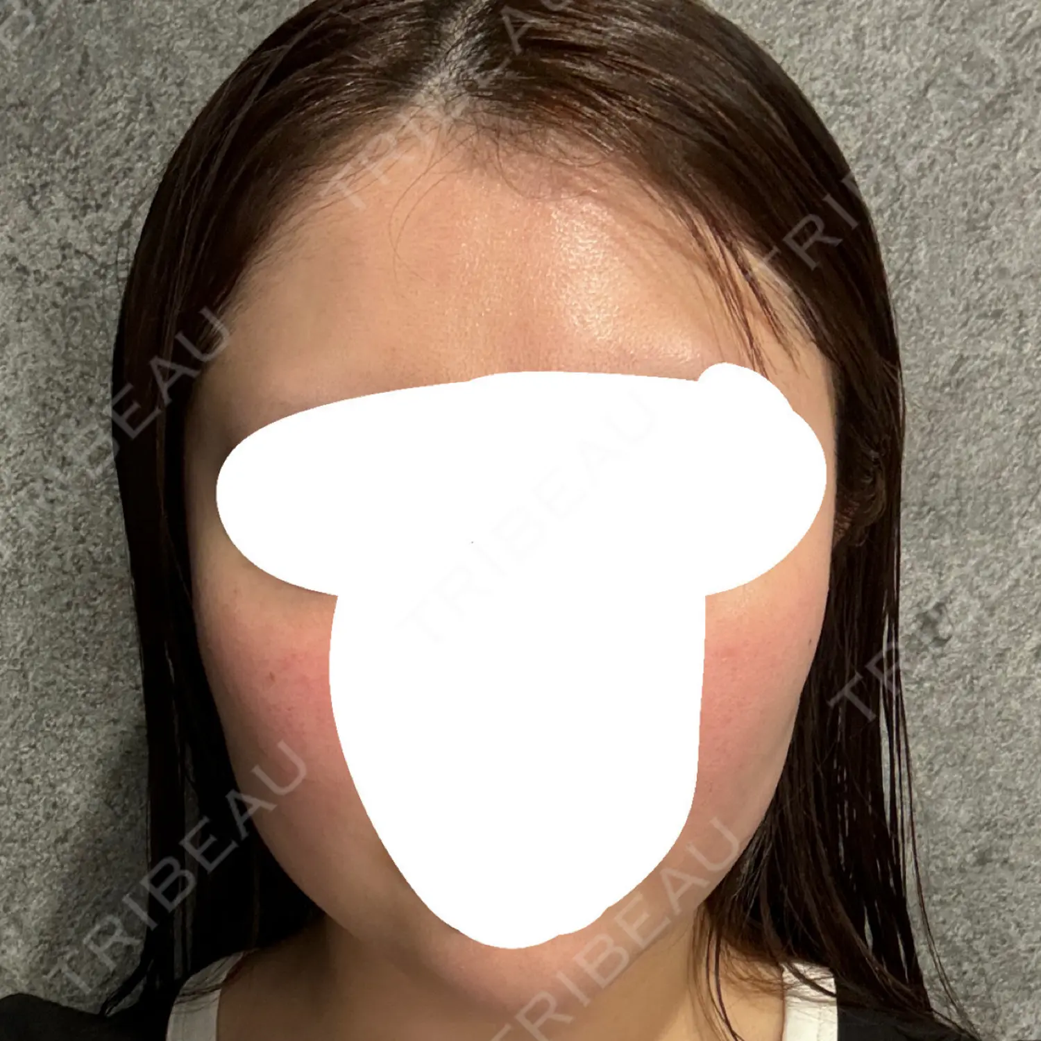 施術前の写真