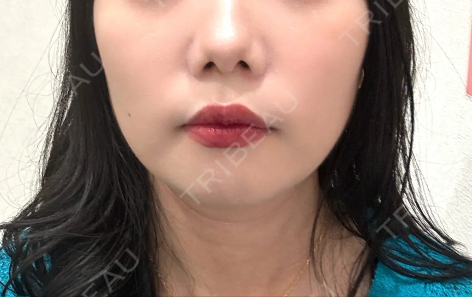 施術前の写真