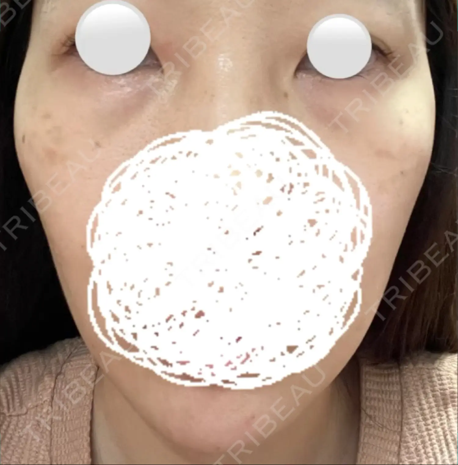 施術前の写真