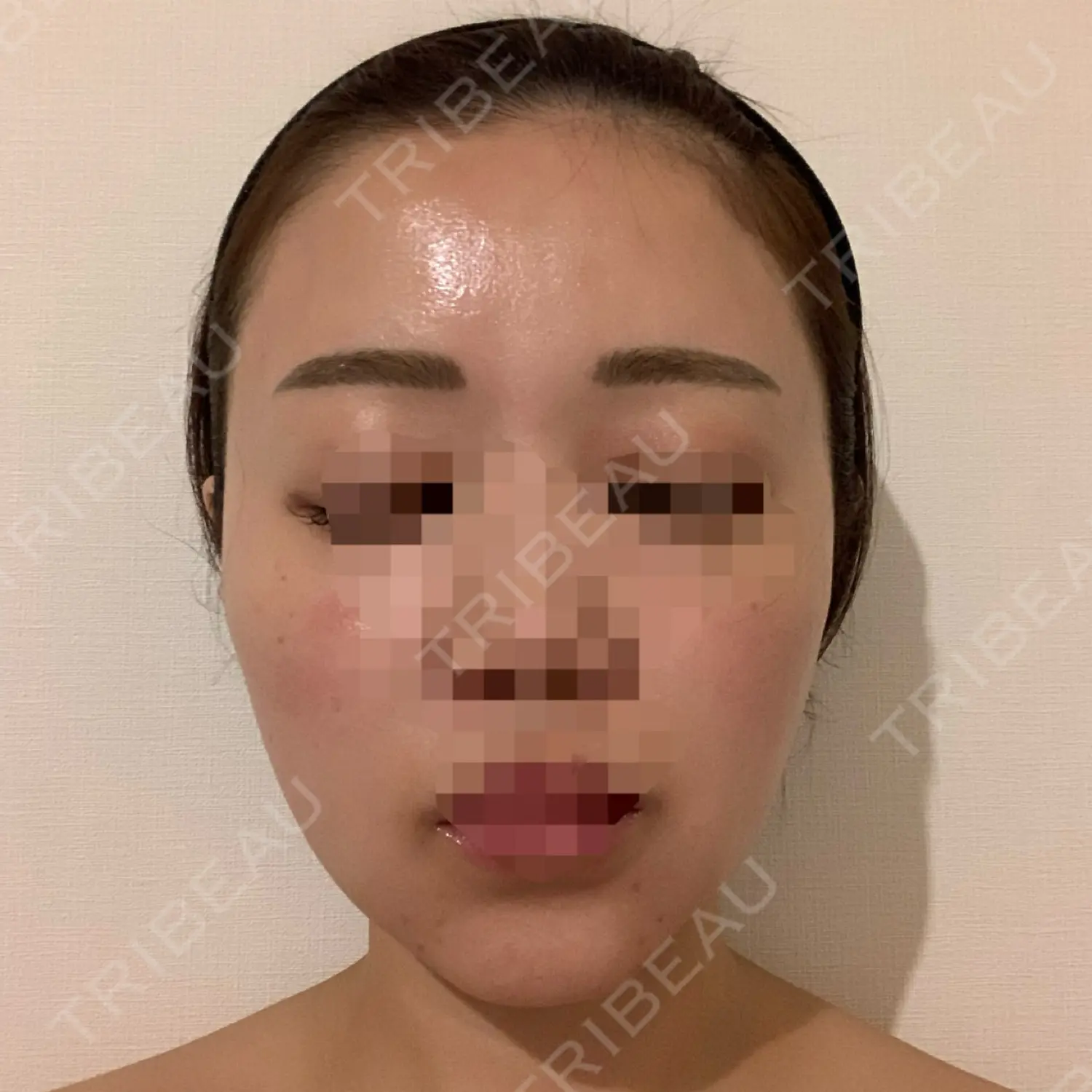 施術前の写真