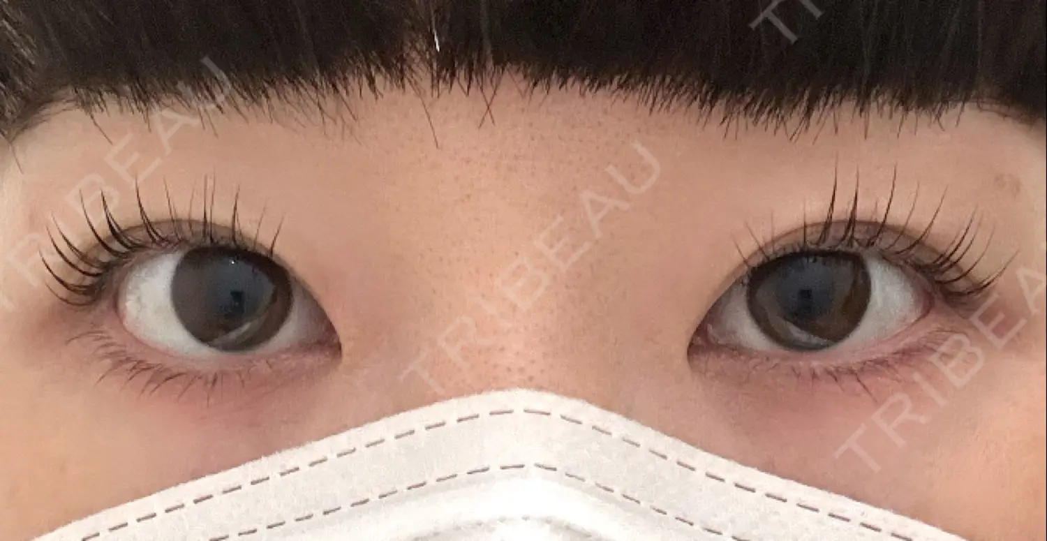 施術前の写真