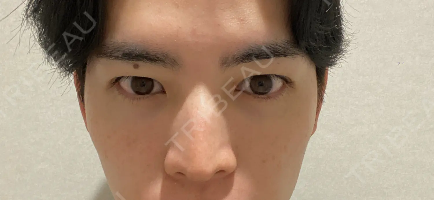施術前の写真
