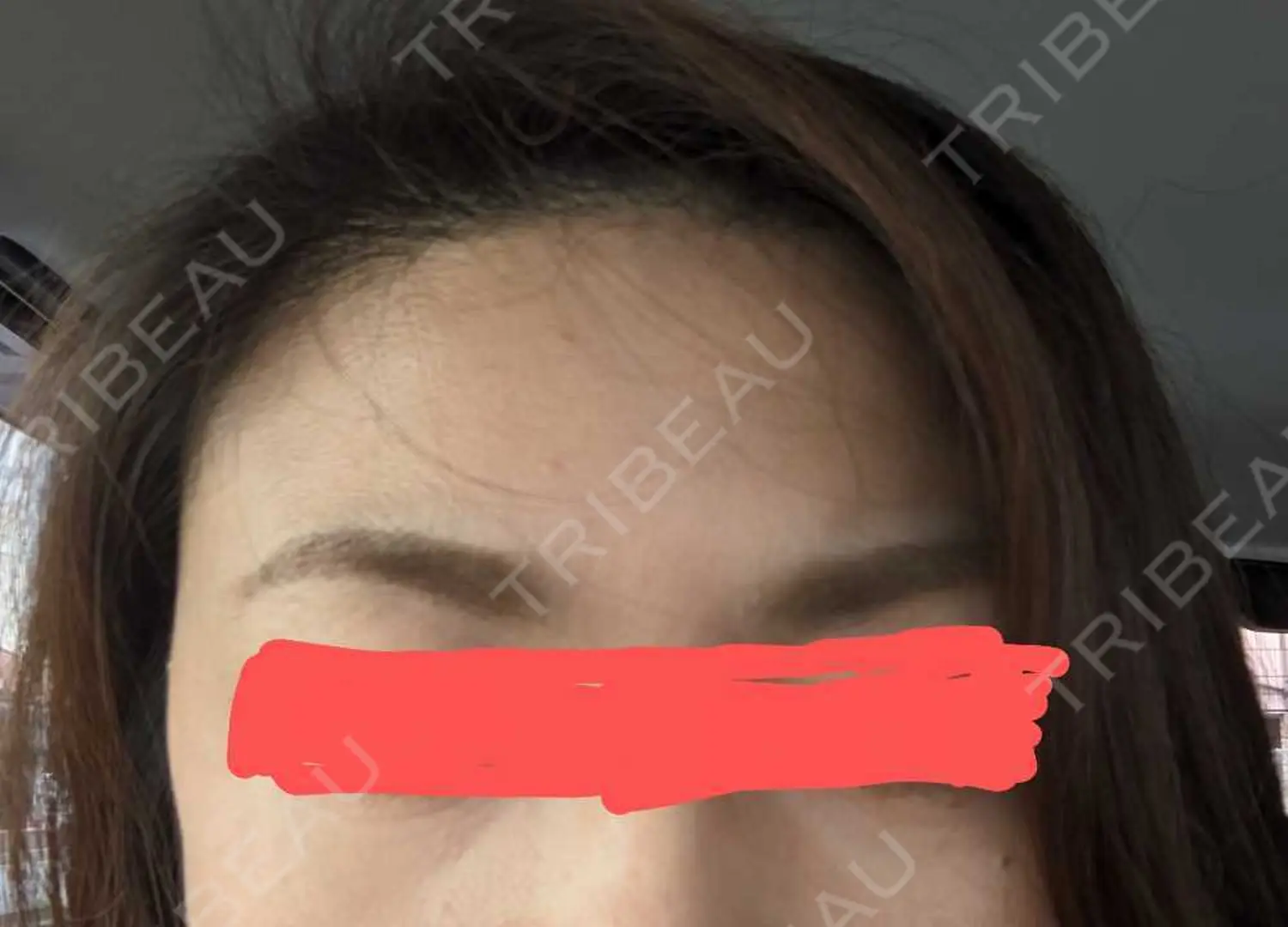 施術前の写真